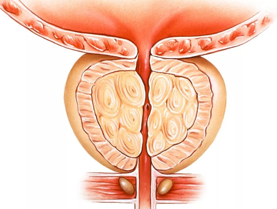 Prostatitida