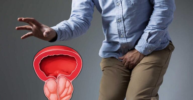 Prevence prostatitidy a adenomu prostaty