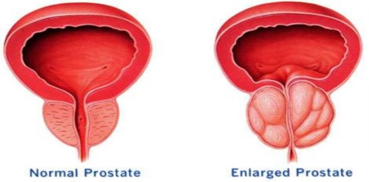 Normální prostata, zanícená prostata